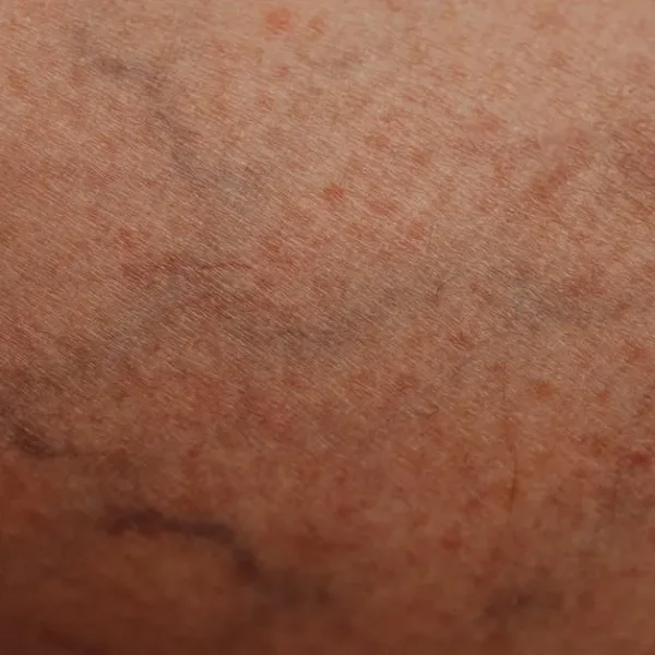Kan AI upptäcka vissa sjukdomar genom att titta på bilder av hud?